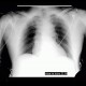 Stenosis of trachea, tracheal intubation: X-ray - Plain radiograph